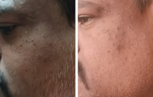 Glutathione IV Drip