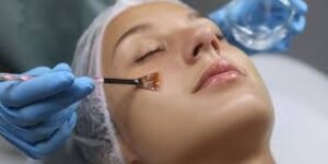 chemical peel