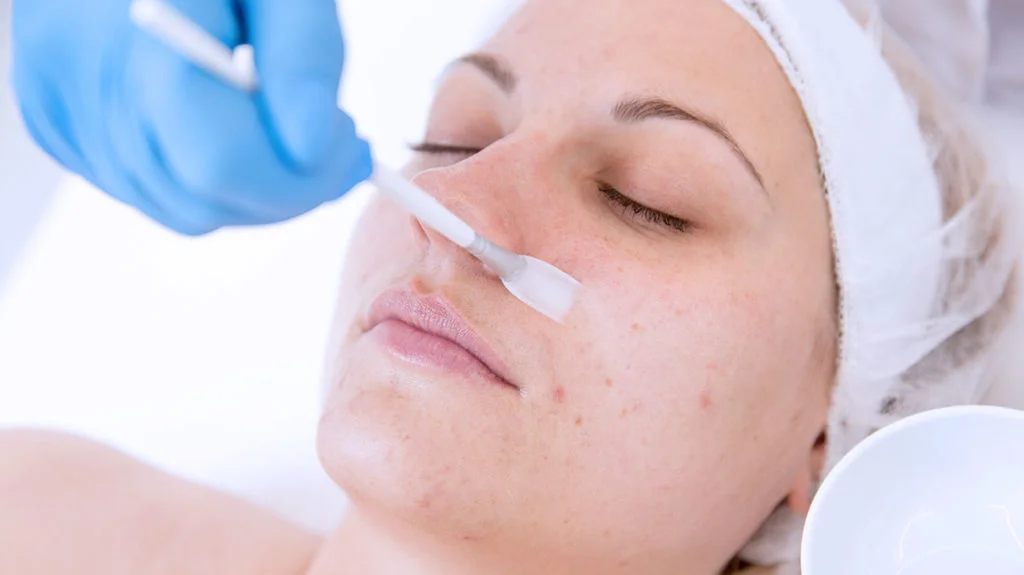 Benefits of Chemical Peels