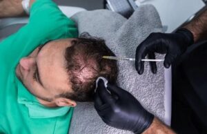 hair prp in Noida