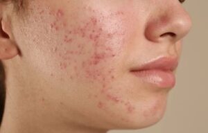 acne scar treatment in gurgaon