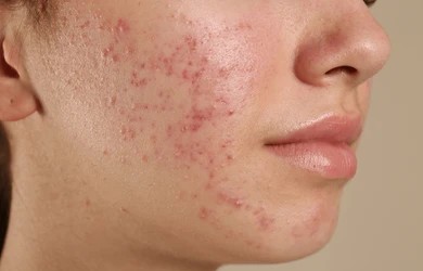 acne scar treatment in gurgaon