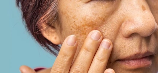 melasma treatment in gurgaon