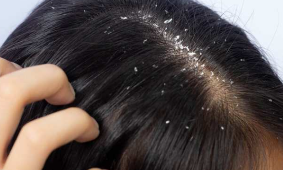 dandruff ttreatment