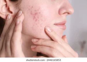 acne scar treatment in gurgaon