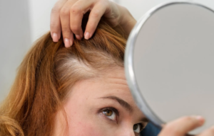 hair loss treatment in delhi ncr