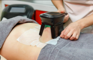 coolsculpting treatment in gurgaon