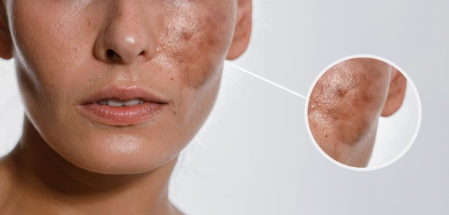 pigmentation k permanent ilaj