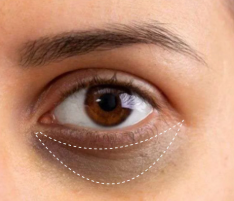 dark circle removal permanently